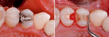 техника реставрации зубов