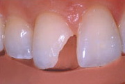 косметическая реставрация зубов