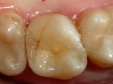 методы реставрации зубов
